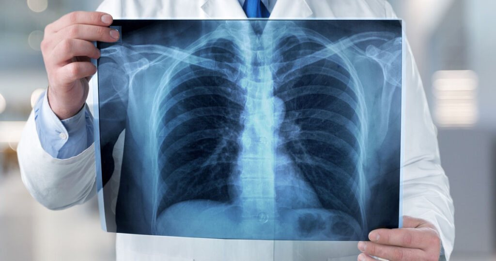 image of a doctor holding a chest x-ray